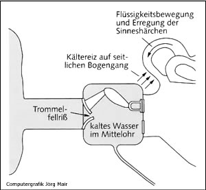 Trommelfellriss