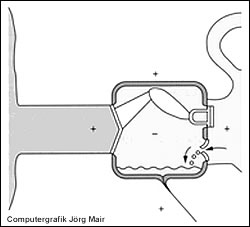 Innenohrbarotrauma