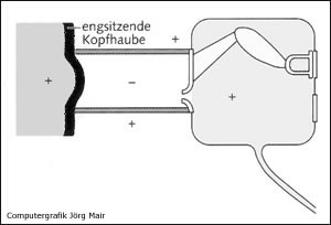 Barotrauma des Gehörgangs