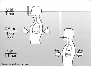 Unterdruckbarotrauma der Lunge